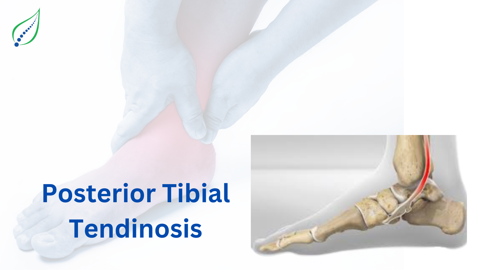 Post Tibial Tendinosis